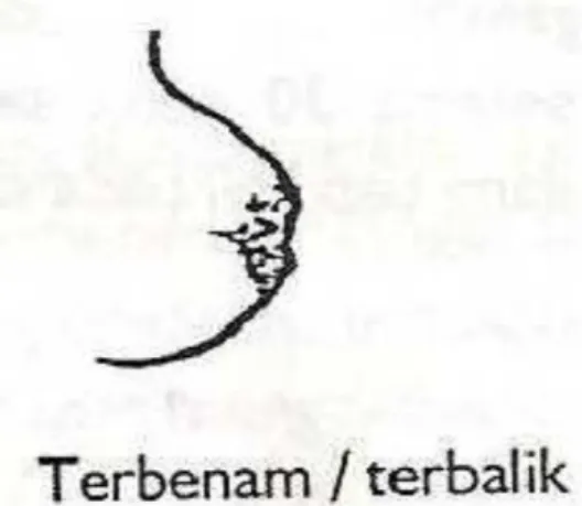 Gambar 5. Bentuk puting susu terbenam/ terbalik 