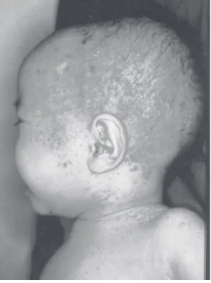 Gambar 1. Lesi pada kepala menyerupai dermatitisseboroik