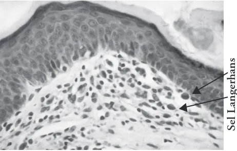 Gambar 2. Sel Langerhans dari biopsi kulit kepaladengan mikroskop biasa