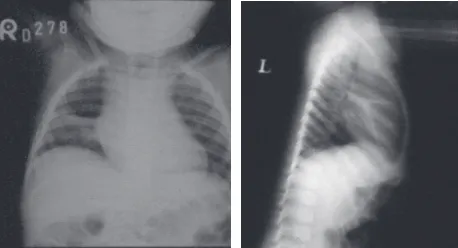 Gambar 1. Foto toraks antero-posterior dan lateral,menunjukkan konsolidasi lobus media paru kanan olehsumbatan pada bronkus kanan
