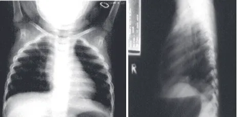 Gambar 2. Foto toraks antero-posterior dan lateralmenunjukkan gambar paru normal, tidak terdapatkonsolidasi.
