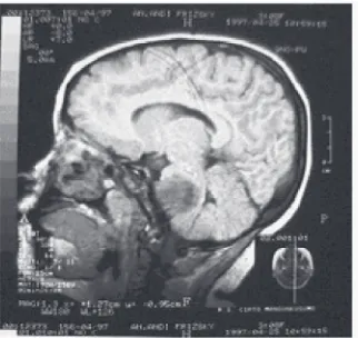 Gambar 3a. Tumor batang otak tanpa kontras