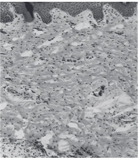 Gambar 4. Gambaran histopatologi menunjukkanhiperkeratosis/ parakeratosis lapisan epidermis kulit