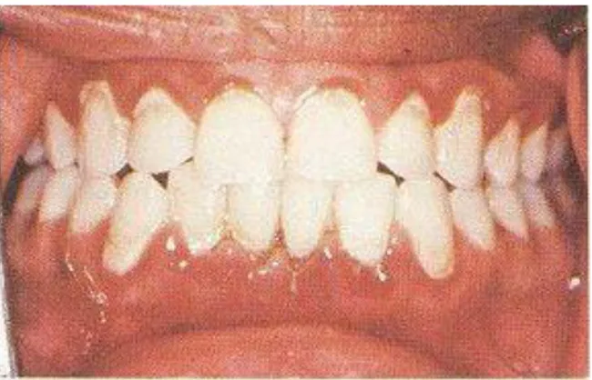 Gambar 3. Gingivitis 