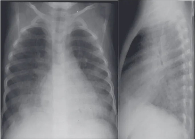 Gambar 1. Limphoid interstitial pneumonitis