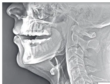 Figure 6.1X-ray of vocal tract for [u]