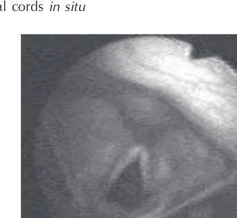 Figure 6.2The vocal cords in situ