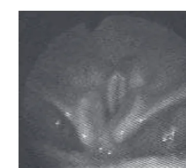 Figure 6.4Vocal cords in adducted position
