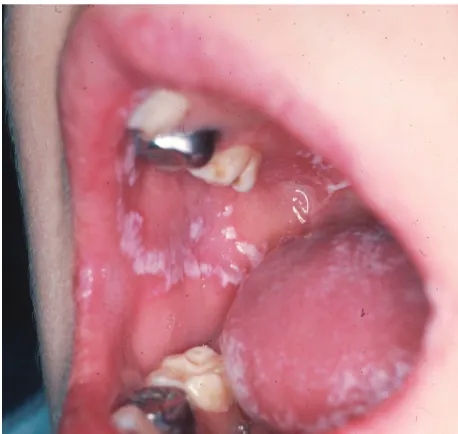 Gambar 1b. Lesi pseudomembran candidiasis 10candidiasis pada palatum12