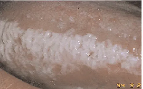 Gambar 5 a. Herpes simpleks  pada bibir12
