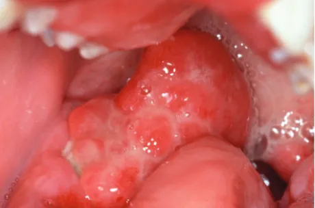 Gambar 8. Kaposi sarcoma12