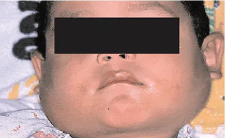 Gambar 10. Aphtous ulcer10