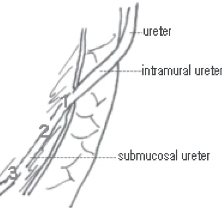 Gambar 2. Bagian ureter yang masuk ke vesikaurinaria sesuai derajat kemungkinan terjadinyarefluks (1.Sangat mungkin, 2.Mungkin, 3.Sangatjarang)Dikutip dari Texas Pediatric Surgical Ass., 2005.8