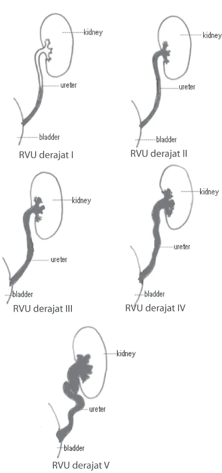 Gambar 5. Derajat RVU (menurut InternationalReflux Study Grading System)8Dikutip dari Texas Pediatric Surgical Ass., 2005.8