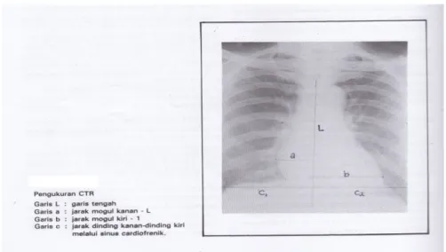 Gambar 2.8. Pengukuran CTR Kardiomegali pada foto thoraks PA dan lateral (Collins, 2007)