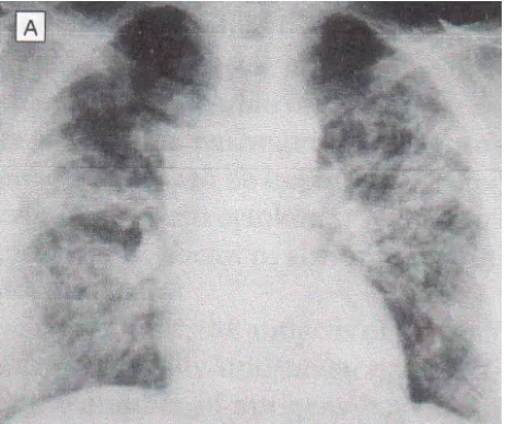 Gambar 2. Gambaran radiologi kasus Pneumonia pneumosistisDikutip dari Kovacs JA dkk, 2001.10