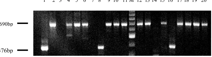 Gambar 1. Gambaran produk PCR pada gel agarose fusi Gena TEL-AML1. Kolom 1: kontrol positif ekternal (REH); kolom 2: kontrol negatif ekternal (HL-60 cell line); Kolom 3, 4, 7, 8, 9, 11, 12-18 adalah sampel dengan TEL-AML1-negatif; kolom 5, 6, 10, 12 adalah