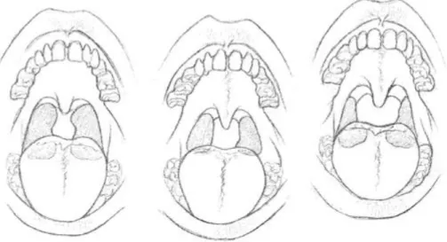 Gambar 2.3Derajat pembesaran tonsil(Dhingra, 2010) 