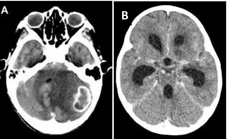 Gambar 1. CT scan yang menunjukkan gambaran tuberkuloma (A) dan 2,28 