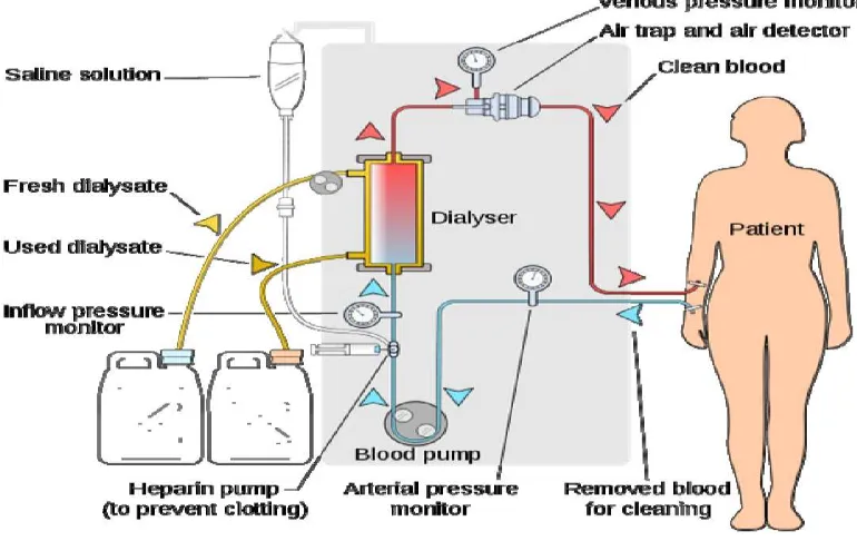 Gambar 2.5. Proses hemodialysis  Sumber : Dikutip dari Suhajono dan Susalit E, Buku ajar ilmu penyakit dalam Jiid I17 