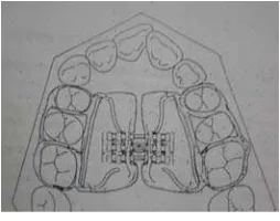 Gambar 1. RPE tipe Haas                   Expander. 8 