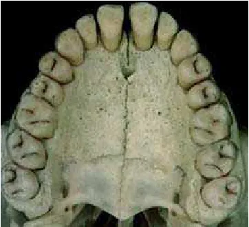 Gambar 10. Sutura midpalatal. 17