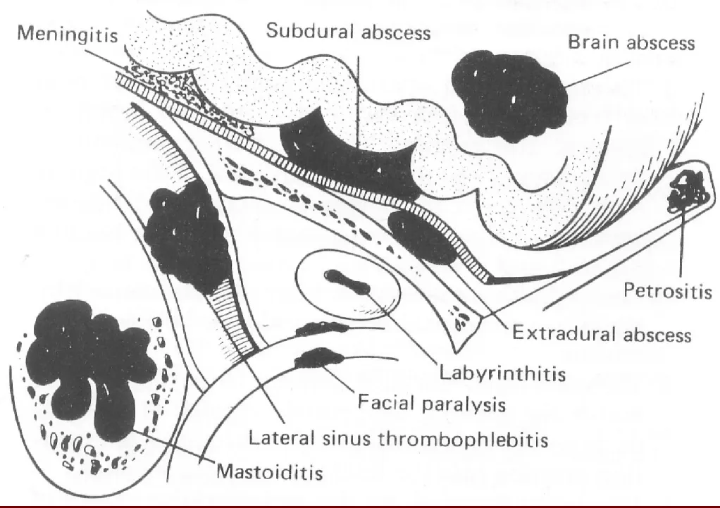 Figure 12.1 Diagram of sites of infection in complications of otitis media. (From Ludman, 1988,  Mawson’s Diseases of the Ear, 5 th edn, London : Edward Arnold, by kind permission)