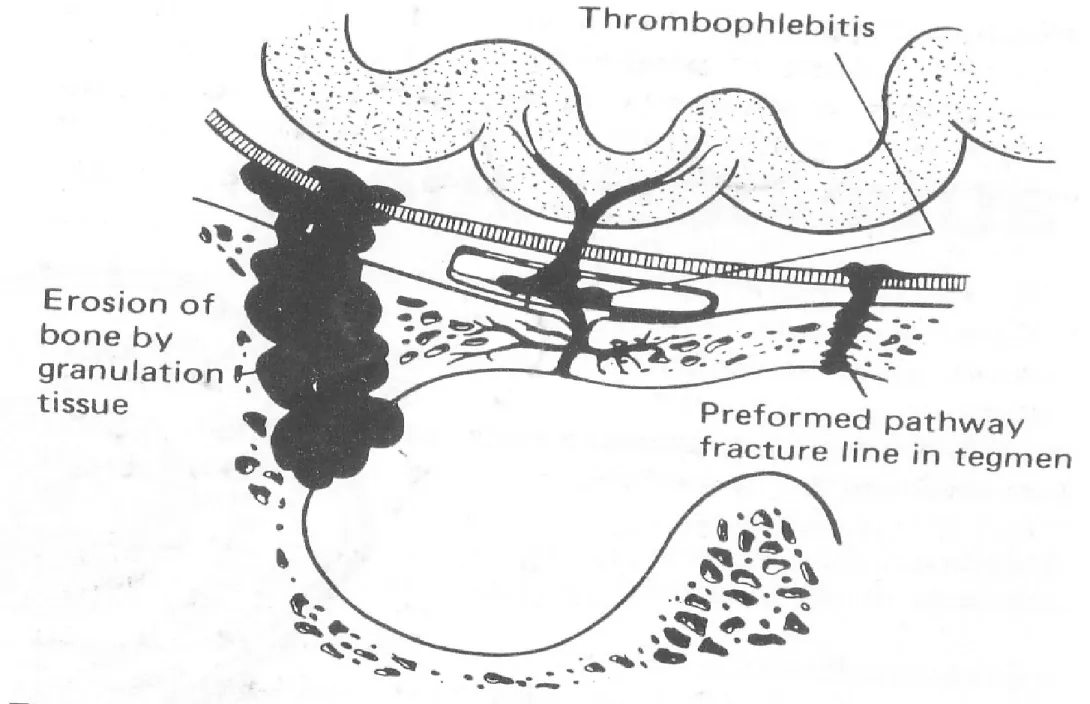 Figure 12.2 Diagram showing routes of spread of infection from the middle ear cavity. (From  Ludman, 1988, Mawson’s Diseases of the Ear, 5th edn, London : Edward Arnold, by kind 