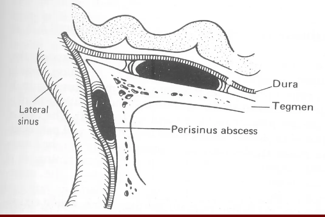 Figure 12.4 Extradural abscess. (From Ludman, 1988, Mawson’s Diseases of the Ear, 5th edn,  London : Edward Arnold, by kind permission) 