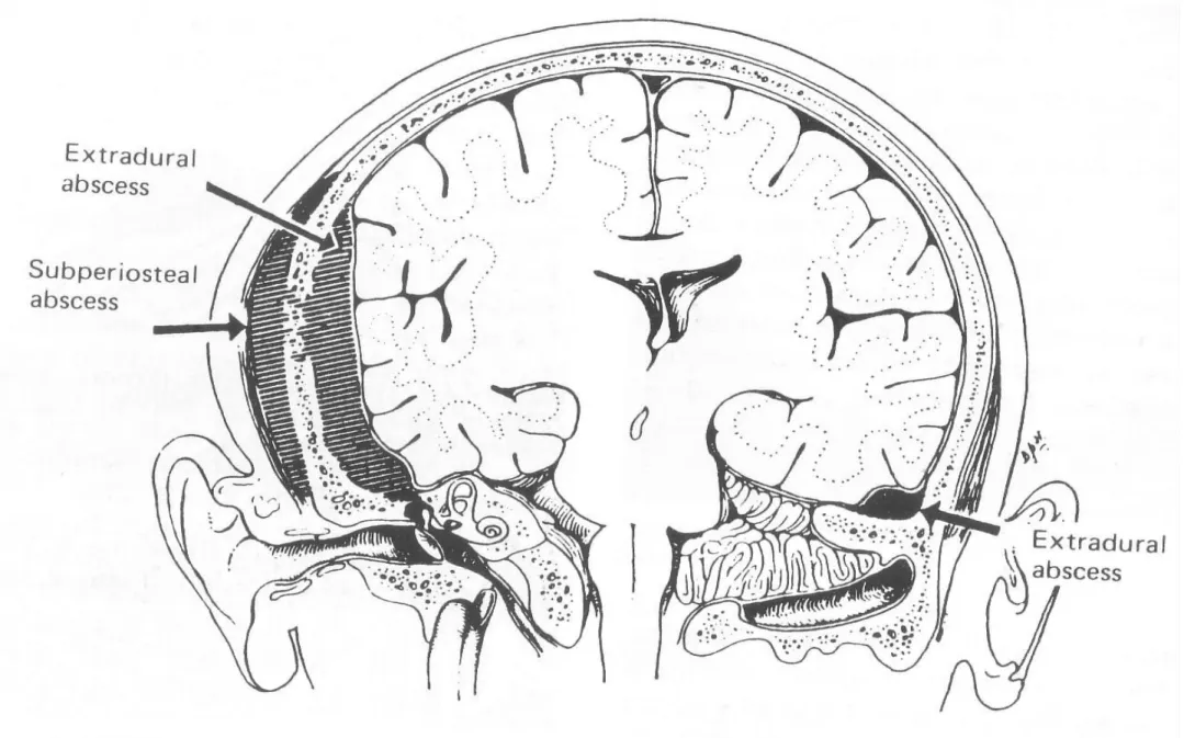 Diagram of middle fossa extradural abscesses showing enlargement of the abscess and  erosion through the vault of the skull to produce 