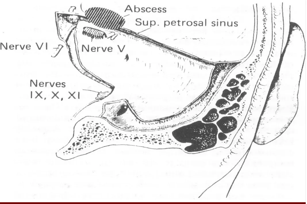 Diagram of the relations of the petrous apex to show proximity of an apical extradural  abscess to the Vth and Vith cranial nerves