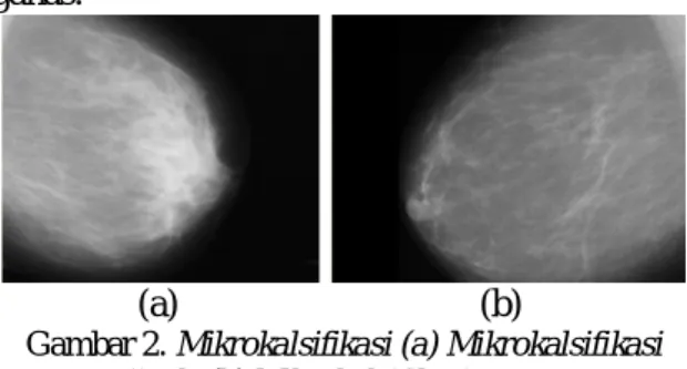 Gambar 1.  Massa (a) massa jinak. (b) massa ganas. 