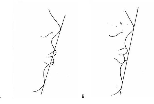 Gambar 1. Evaluasi konveksitas skeletal dan jaringan lunak wajah menunjukkan profil datar,     cembung (konveks) dan cekung (konkaf) 16 