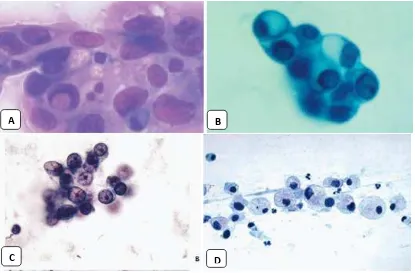 Gambar 2.6. Sitologi adenocarcinoma24 