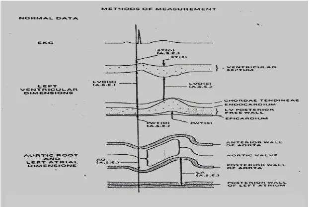Gambar 2.3. Pengukuran  LVEDd, IVSd dan PWd  dengan Teknik M-mode (38)