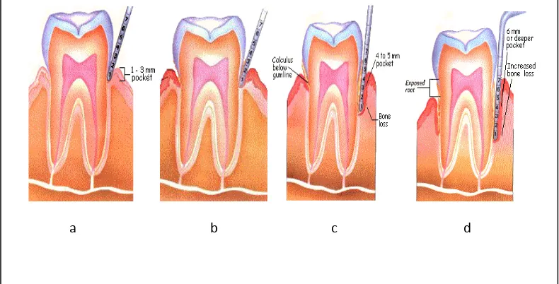 Gambar 2.  Tahapan penyakit periodontal19 