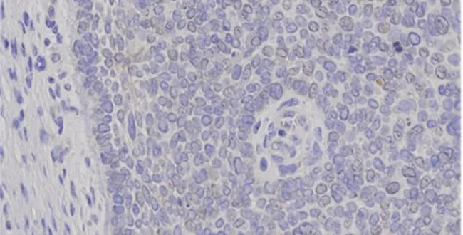 Gambar  2  :  Tampak  sel-sel  basal  tersusun  palisade  pada  pinggir  lesi  KSB  dengan  bagian  tengah  terdiri  dari  sel-sel  monomorf  poligonal  yang  tersusun  tidak  beraturan