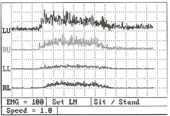 Gambar 2.6. Tampilan EMG permukaan yang telah diproses (Criswell, 2011) 