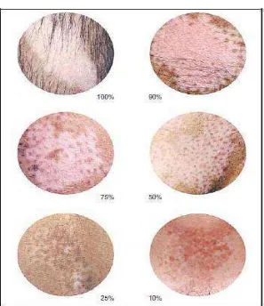 Gambar  2.1  Derajat depigmentasi VASI. Panduan yang  telah     distandarisasi  untuk memperkirakan derajat pigmentasi pada vitiligo (dikutip dari kepustakaan no.50) 