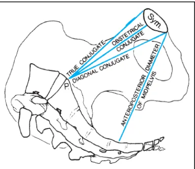 Gambar 2.2. Gambaran tiga diameter anteroposterior pintu atas  panggul: konjugata vera, konjugata obstetris dan konjugata diagonalis yang dapat diukur secara klinis