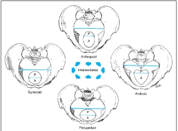 Gambar 2.5. Empat tipe panggul dengan klasifikasi Caldwell-Moloy. Garis yang melintasi diameter transversal terlebar membagi pintu atas menjadi segmen posterior dan anterior