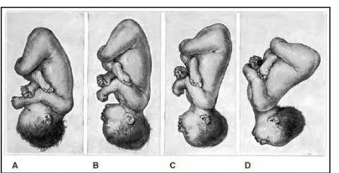 Gambar 2.8. Letak memanjang, presentasi kepala. Perbedaan sikap  tubuh janin pada presentasi (A) verteks, (B) sinsiput, (C) wajah, (D) dahi