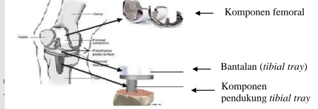 Gambar 1 Prostetik sendi lutut total (Musib 2011) 
