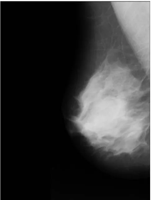 Gambar 3.8 Contoh mammogram M IAS mdb001 