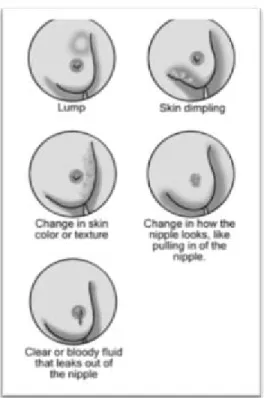 Gambar 2.2 gejala pada payudara 