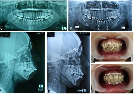 Gambar 5. Foto kontrol radiografi. Foto Panoramik A. pre operasi dan B. pasca operasi; fotosefalometri C