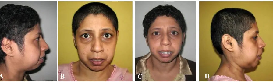 Gambar 7. Foto close up penderita, A, B. pre operasi; C, D. pasca operasi.