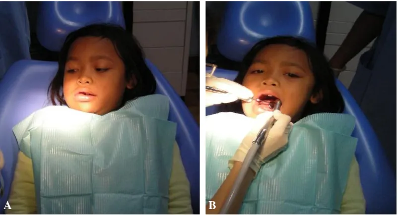 Gambar 1. A. Profil pasien sebelum tindakan mouth preparation, B. Penambalan gigigeligi pasien
