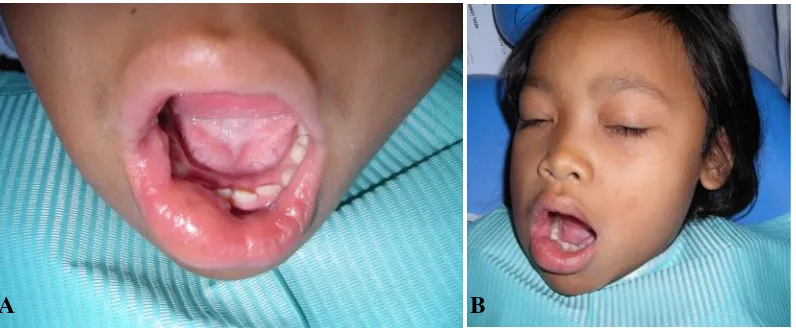 Gambar 2. Kondisi pasien setelah tindakan penambalan dan pencabutan A. intra oral, danB