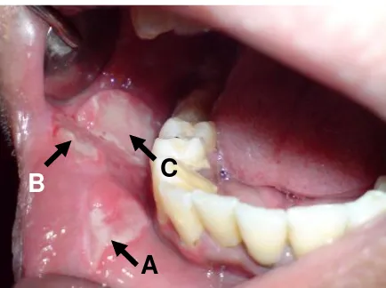 Gambar 1. Tampakan intra oral pada kunjunganpertama, ulser multipel pada mukosa labial kananbawah dan mukosa bukal kanan